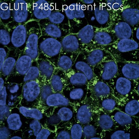 Unter dem Mikroskop sind links die Zellen eines gesunden Menschen zu sehen und rechts die von Macie. Sie leidet unter dem GLUT1-Defizit-Syndrom. Die Zuckertransporter (GLUT1) fluoreszieren grün. Bei gesunden Menschen befinden sie sich in den Zellhüllen (blau: Zellkern). In Macies Fall ist nur ein Teil der Transporter in diesen Membranen. Der Zuckertransport ist daher stark beeinträchtigt