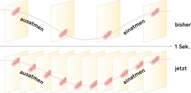 Aus diesem Grund lässt sich die Anzahl der Aufnahmen erhöhen – und zwar von bisher vier auf über zehn Bilder pro Sekunde. Dank dieser schnelleren Bildfolge lässt sich die Position des Tumors beim Atmen noch genauer bestimmen.